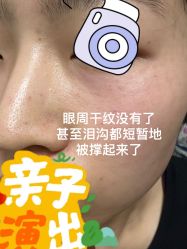 点击看大图 体验后-臻悦医疗美容整形门诊部