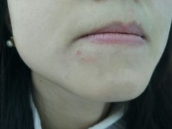 -痘瑞仕·专业祛痘国际连锁