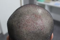 点击看大图 -大麦微针植发丨全国连锁