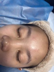 体验前-广州健丽·去眼袋医疗美容机构