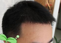 -大麦微针植发丨全国连锁