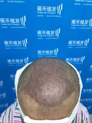 -雍禾植发全国连锁