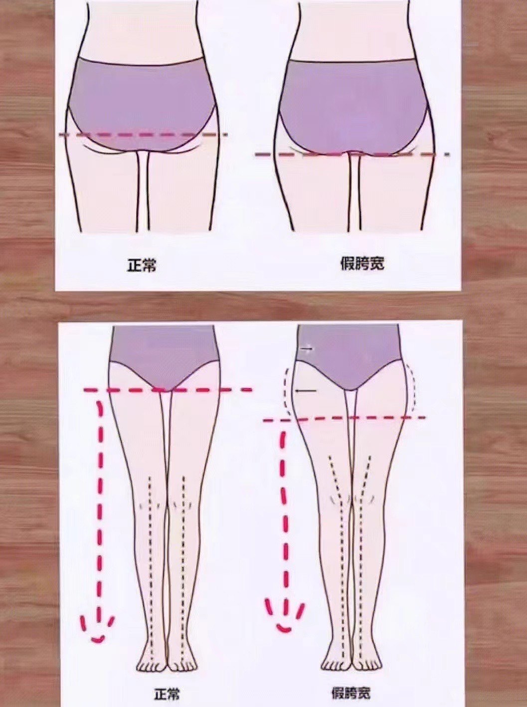 胯骨不对称图片