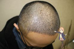 -大麦微针植发丨全国连锁