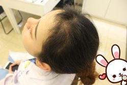 -大麦微针植发丨全国连锁