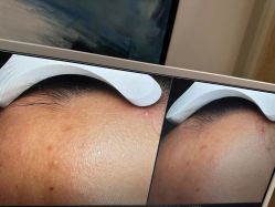 -苑苑vbeauty科技美容SPA