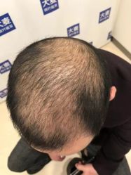 体验前-大麦微针植发丨全国连锁