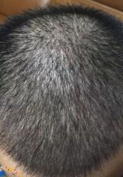 -大麦微针植发丨全国连锁