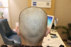 -大麦微针植发丨全国连锁