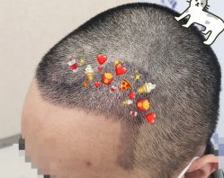 -大麦微针植发全国连锁