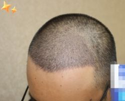 -大麦微针植发丨全国连锁