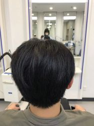 体验后-大麦微针植发全国连锁