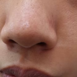 体验后-东莞缔美美容医院