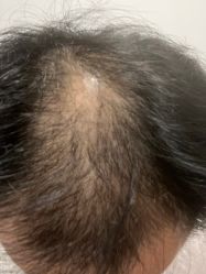 点击看大图 -大麦微针植发丨全国连锁