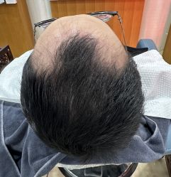 -大麦微针植发全国连锁