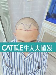 -牛大夫植发
