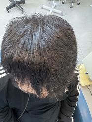 点击看大图 -大麦微针植发全国连锁