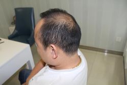 -大麦微针植发丨全国连锁