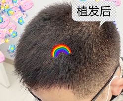 -大麦微针植发全国连锁