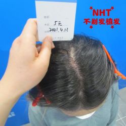-碧莲盛·不剃发植发