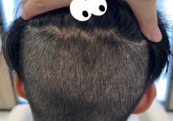 -大麦微针植发全国连锁