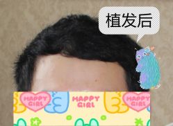 -大麦微针植发全国连锁