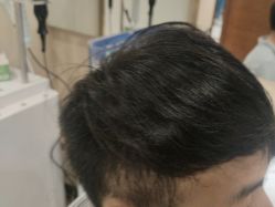 -碧莲盛·不剃发植发