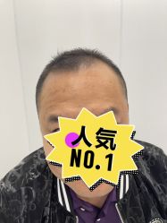体验后-大麦微针植发全国连锁