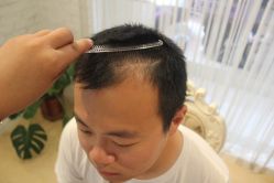 点击看大图 -大麦微针植发丨全国连锁