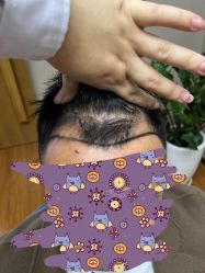 -大麦微针植发全国连锁