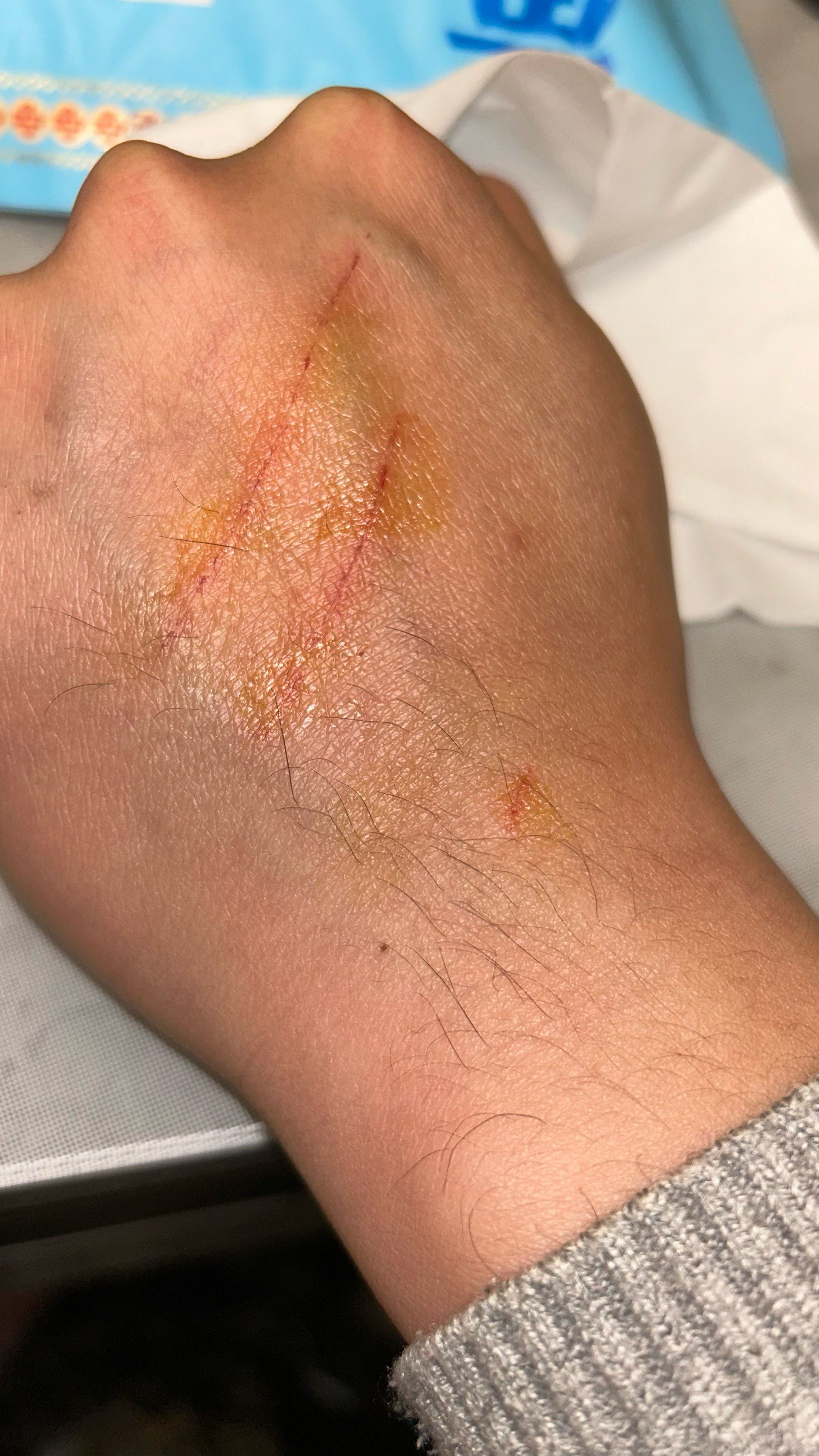 小伤口的治疗秘诀