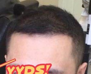 -大麦微针植发丨全国连锁