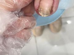 -世龙世家灰指甲·甲沟炎·跖疣护理·修脚(东江湾路店)