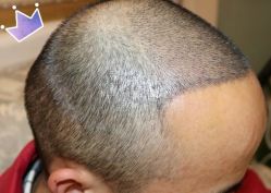 -大麦微针植发丨全国连锁