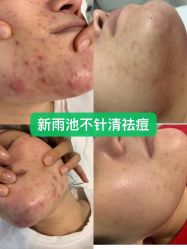 -新雨池不针清祛痘