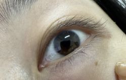 体验前-紫洁俪方（北京）医疗美容