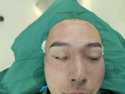 -大麦微针植发丨全国连锁