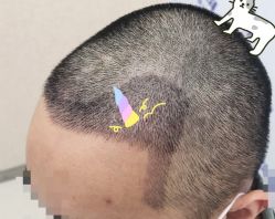 -大麦微针植发全国连锁