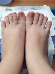 iphone_upload_pic-EPAI·灰指甲·甲沟炎·嵌甲护理