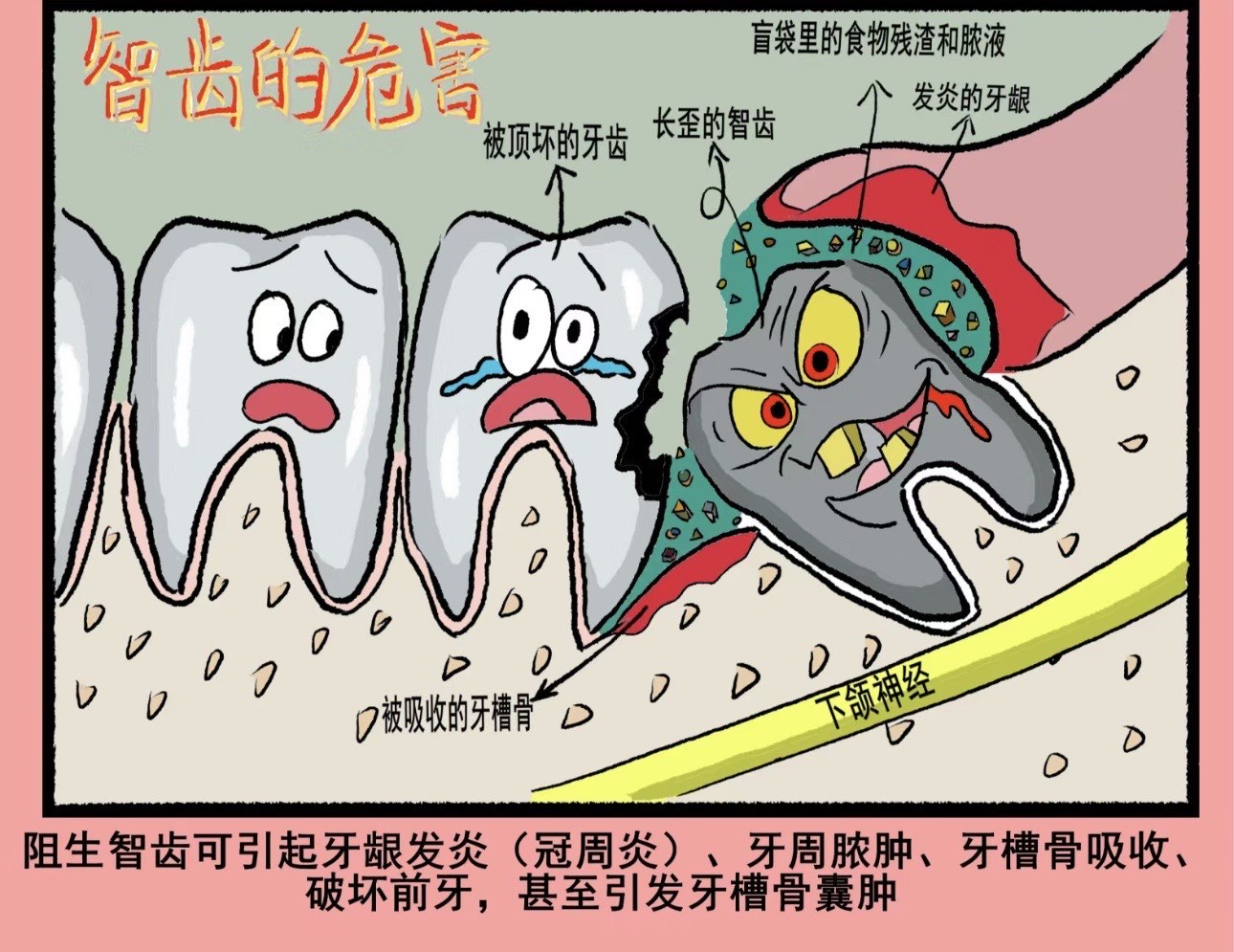 智齿盲袋冲洗步骤图图片