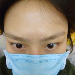 体验后-More摩尔医美の注射线雕光电中心