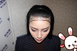 点击看大图 -大麦微针植发丨全国连锁