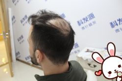 -大麦微针植发丨全国连锁