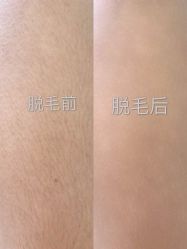 -HEYAN荷妍专业脱毛连锁机构