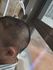 -碧莲盛·不剃发植发