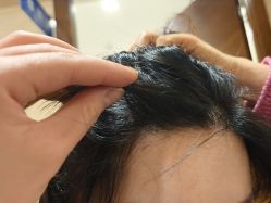 -碧莲盛·不剃发植发