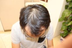 -大麦微针植发丨全国连锁