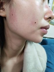 -北京美痣堂古方祛痣斑疣瘊