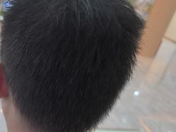 -碧莲盛·不剃发植发
