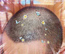 -大麦微针植发全国连锁